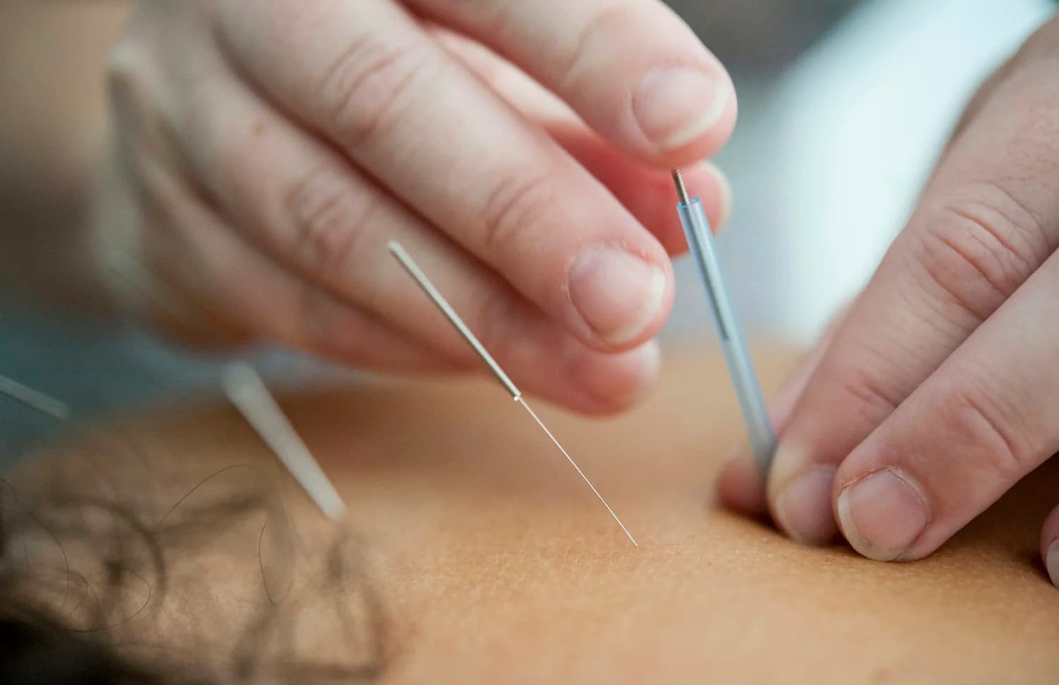 Dry needling & acupuncture